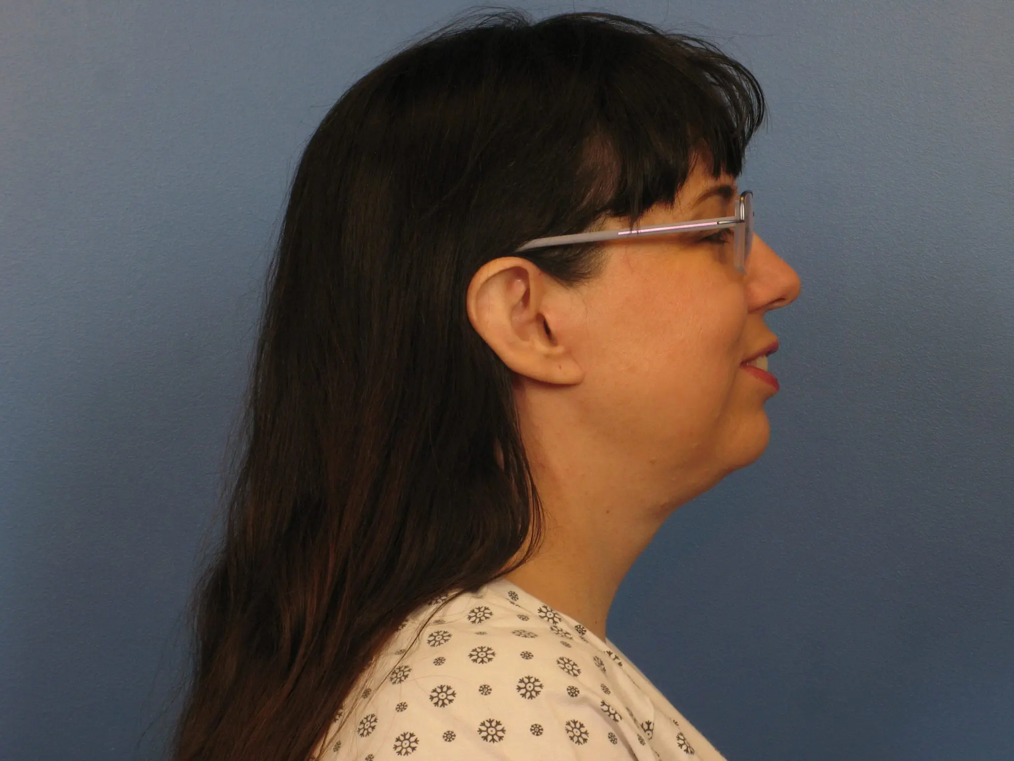 Neck Lift Patient Photo - Case 405 - after view