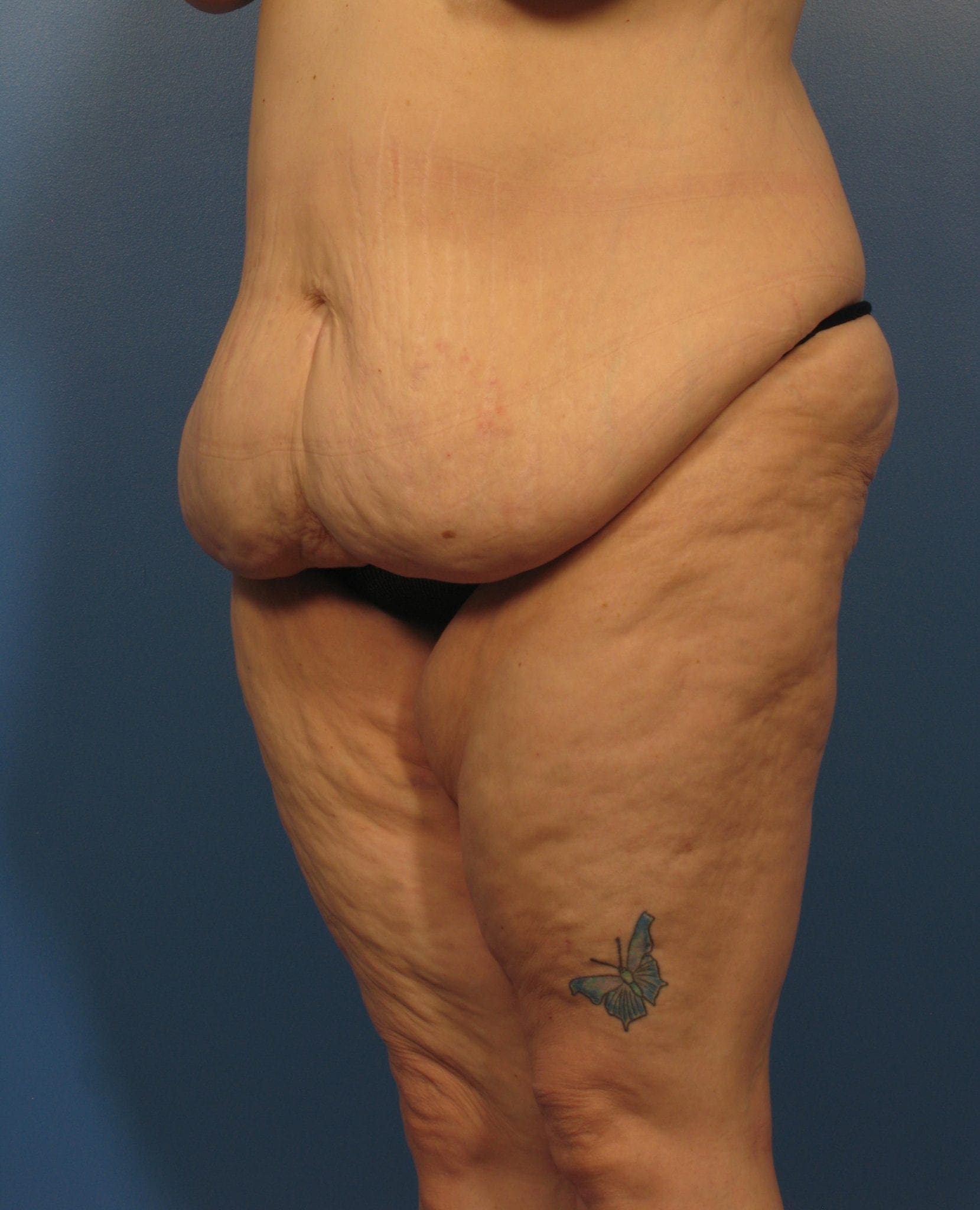 Tummy Tuck Patient Photo - Case 405a - before view-