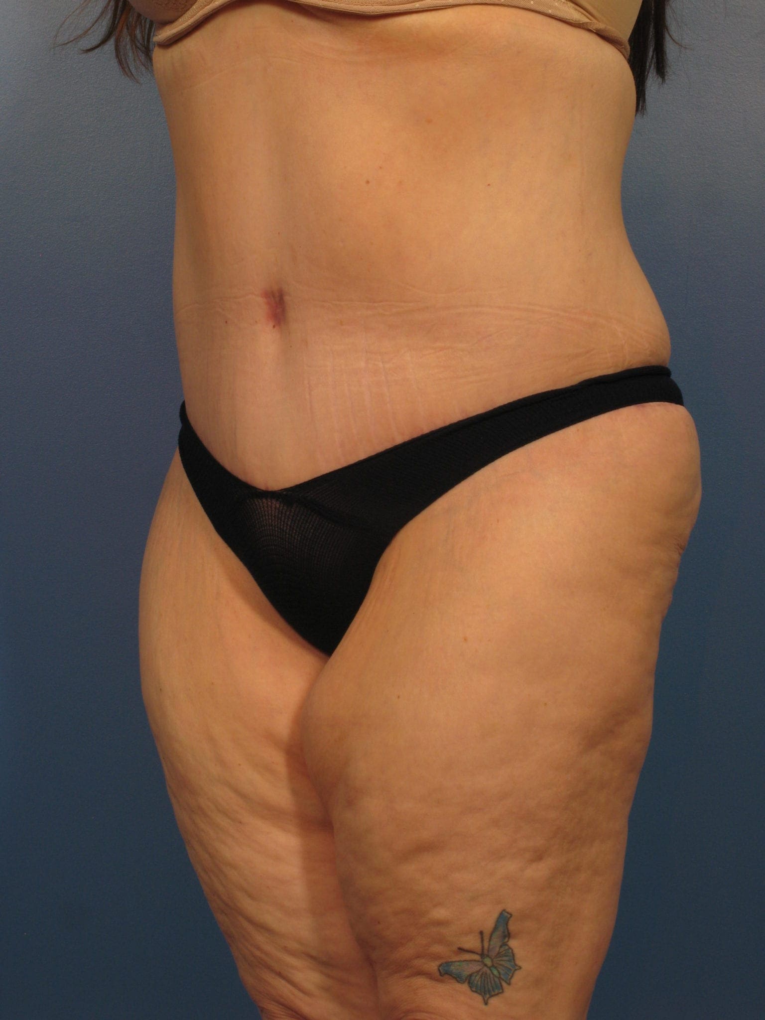 Tummy Tuck Patient Photo - Case 405a - after view-0