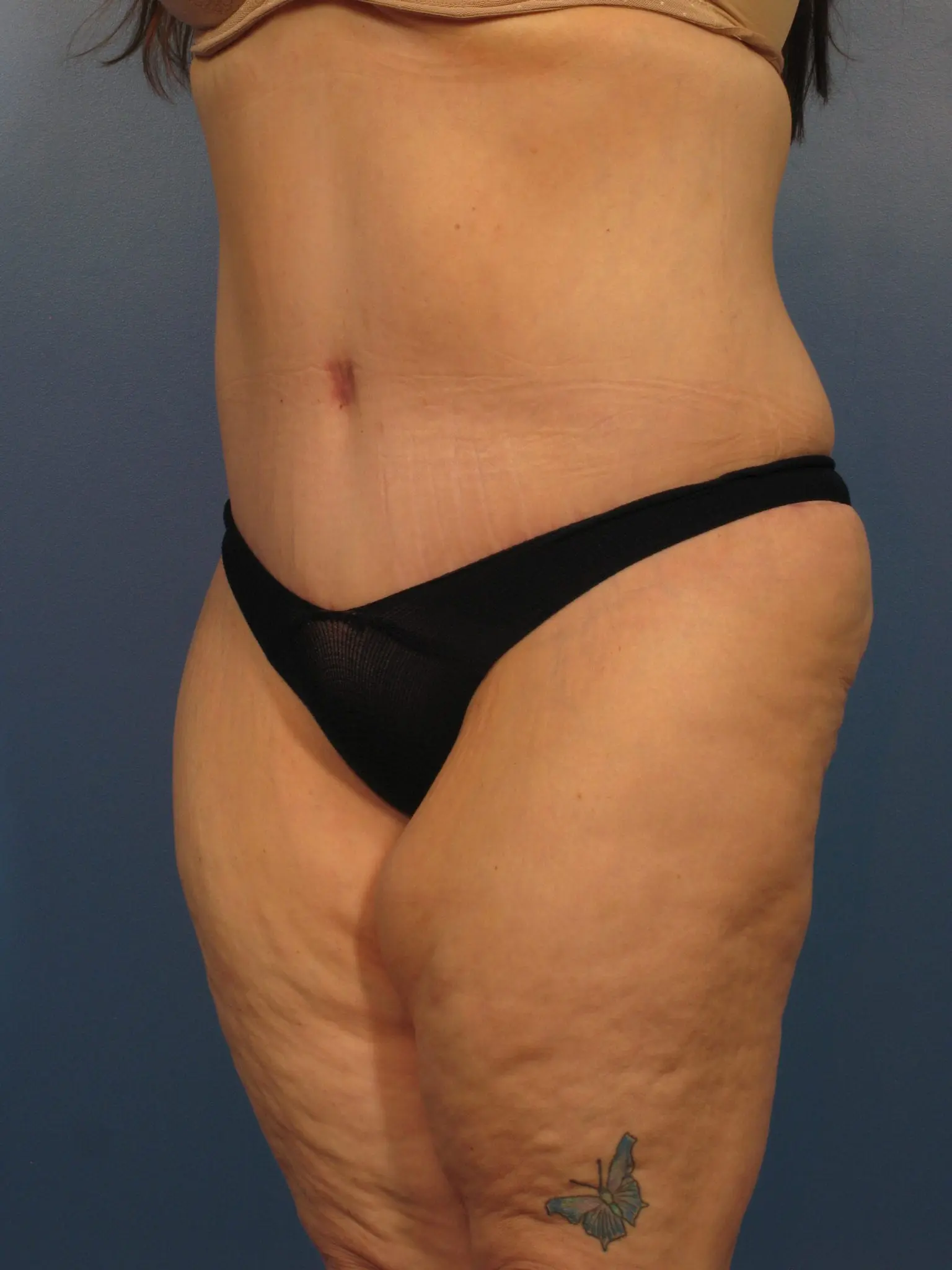 Tummy Tuck Patient Photo - Case 405a - after view