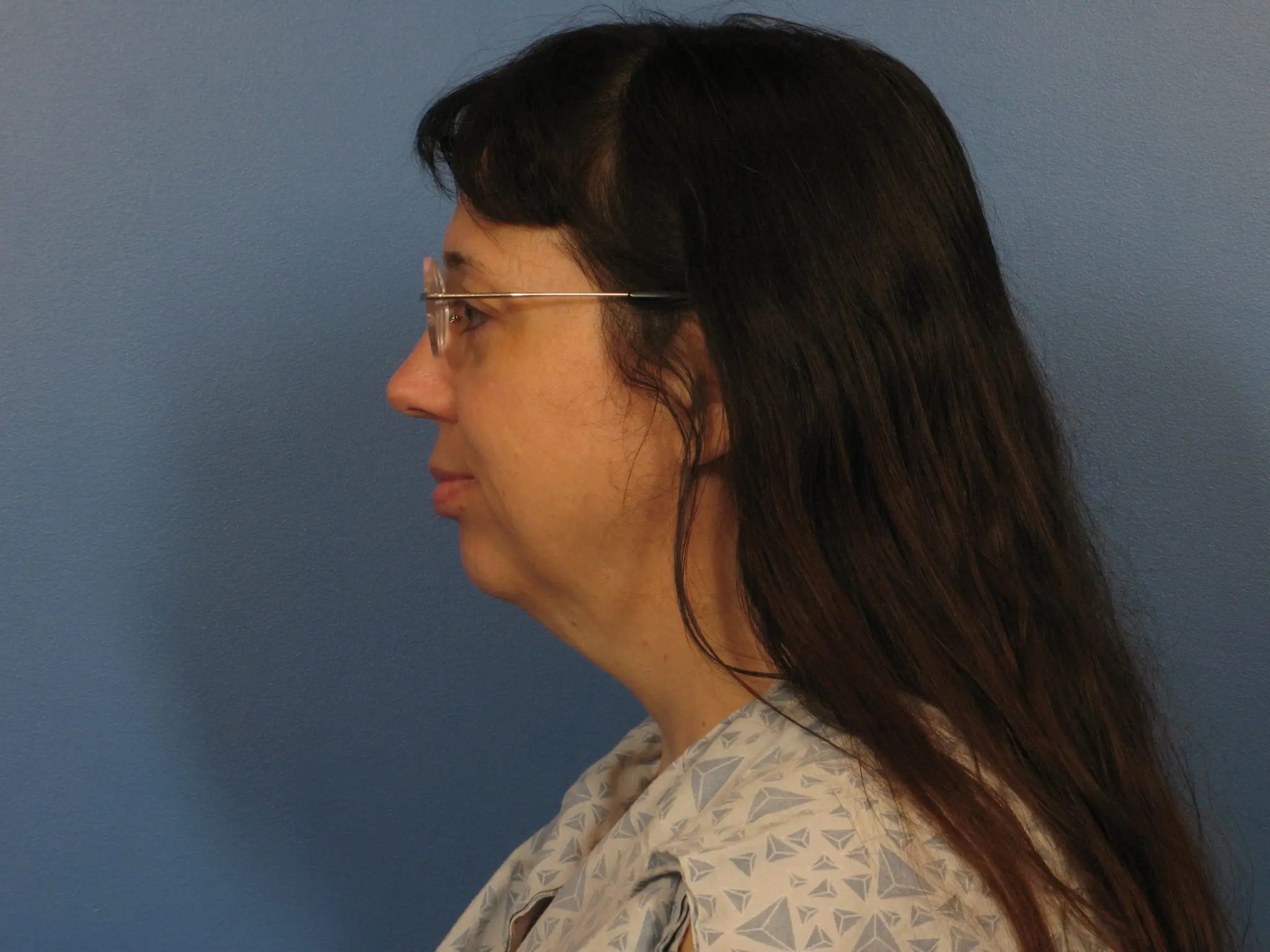 Neck Lift Patient Photo - Case 405 - before view-1