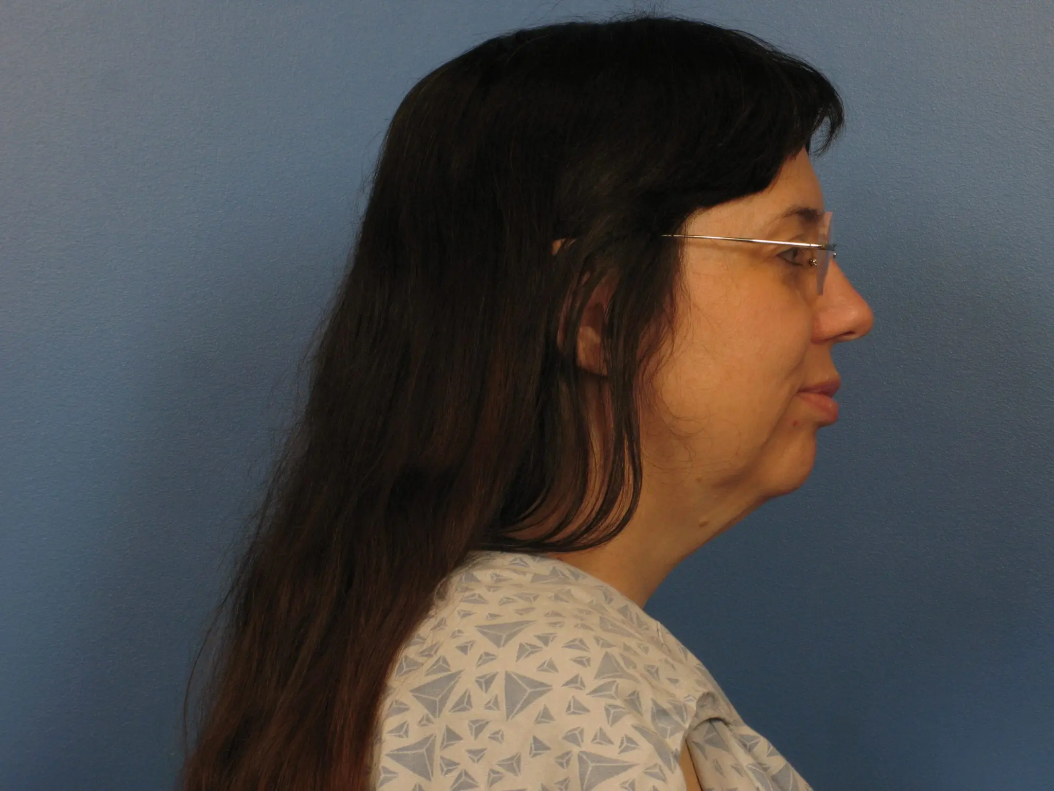 Neck Lift Patient Photo - Case 405 - before view-