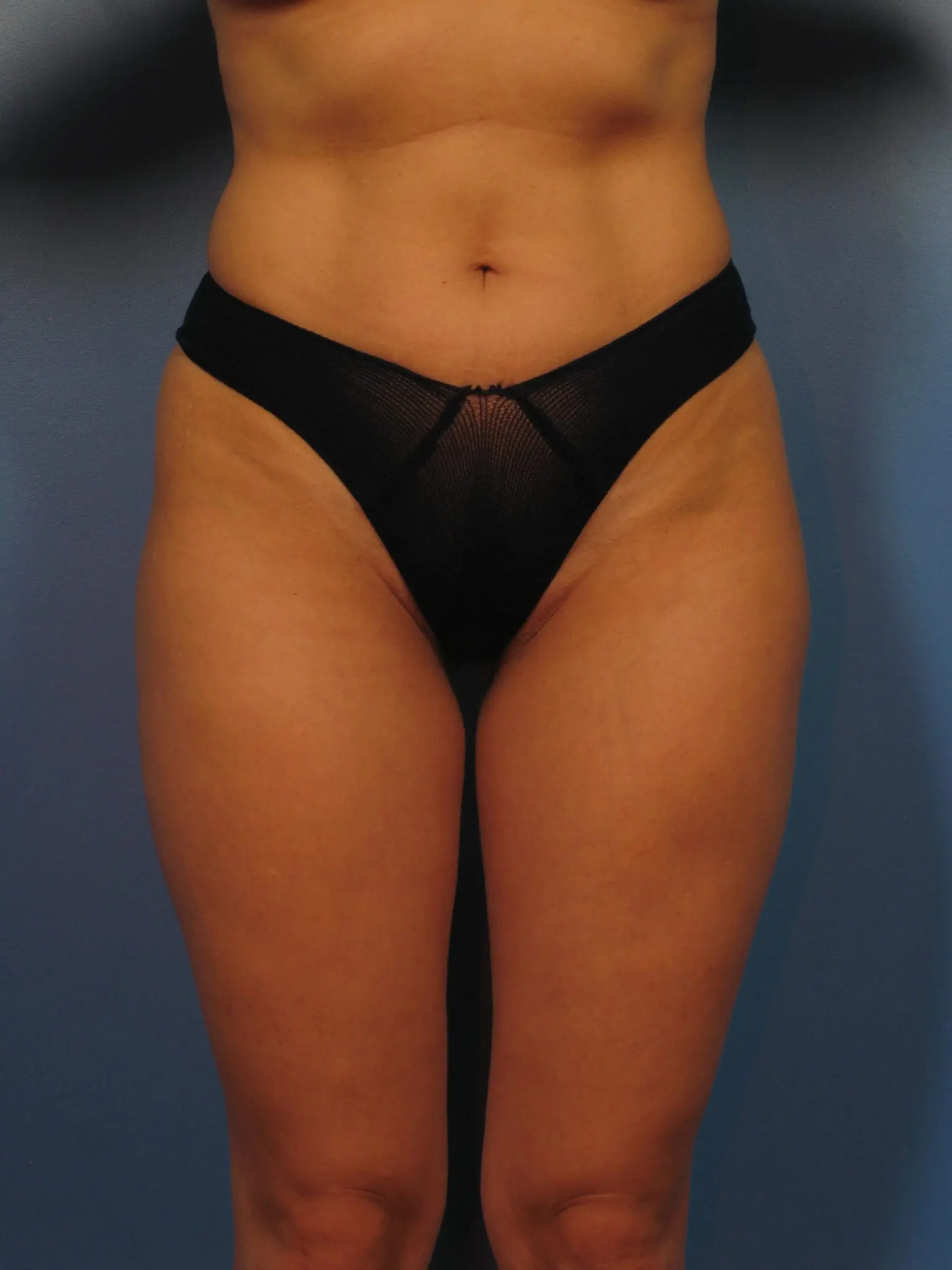 Liposuction Patient Photo - Case 406 - after view