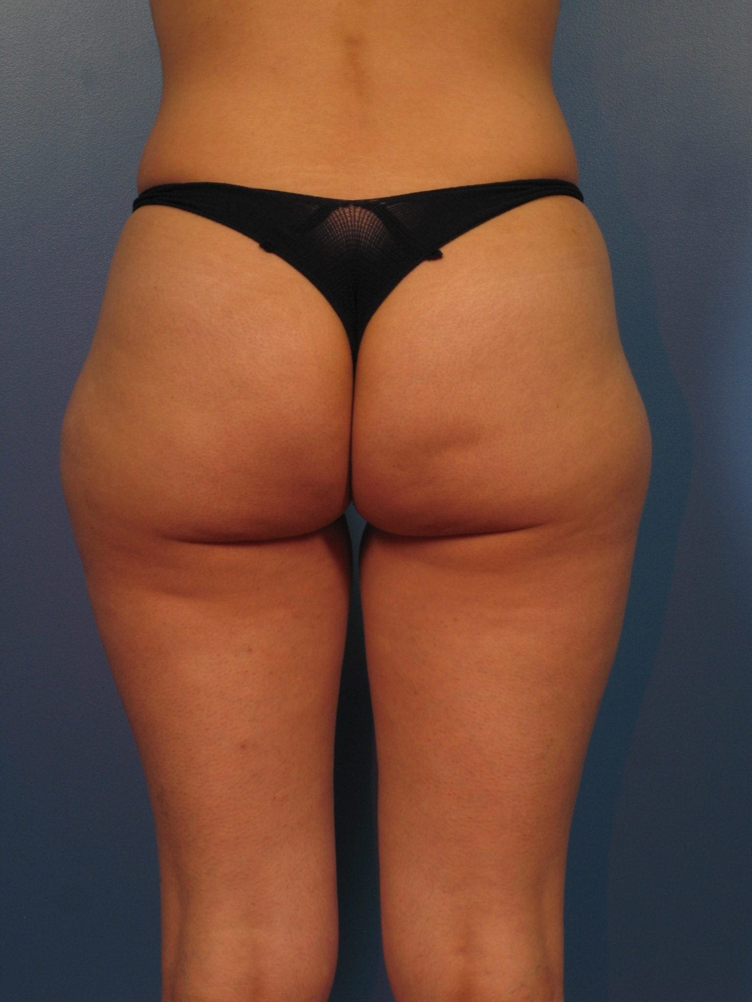 Liposuction Patient Photo - Case 406 - before view-1