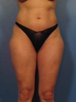 Liposuction - Case 406 - Before