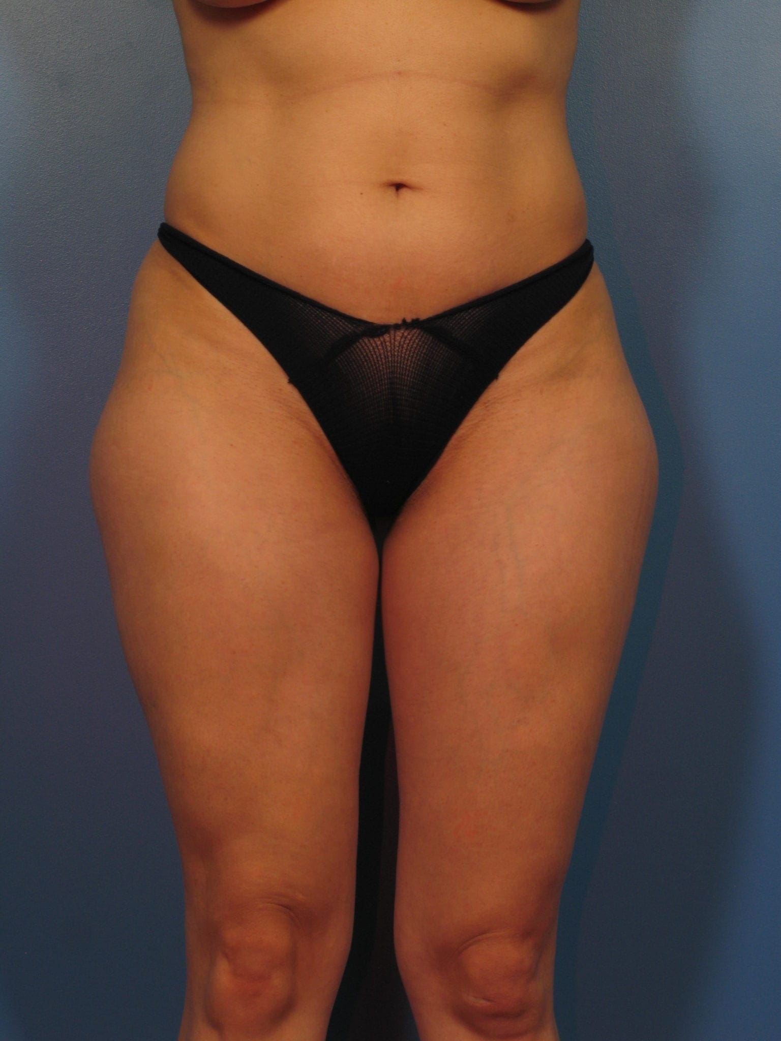 Breast Lift Patient Photo - Case 406a - before view-2