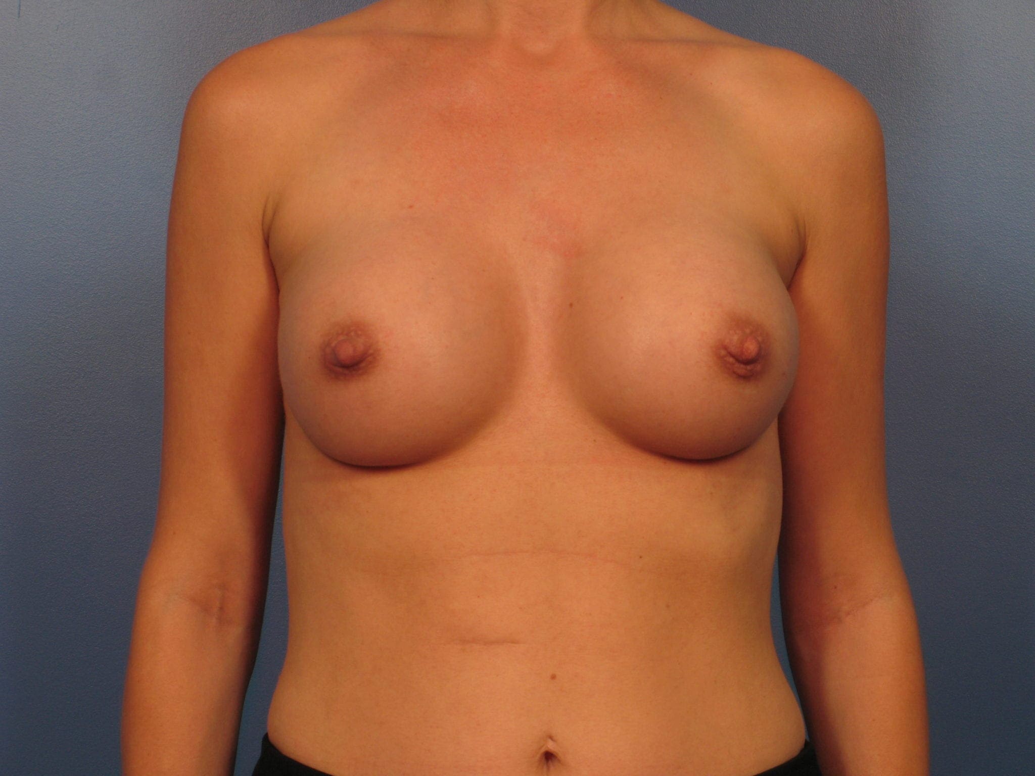 Breast Augmentation Patient Photo - Case 407 - after view-1