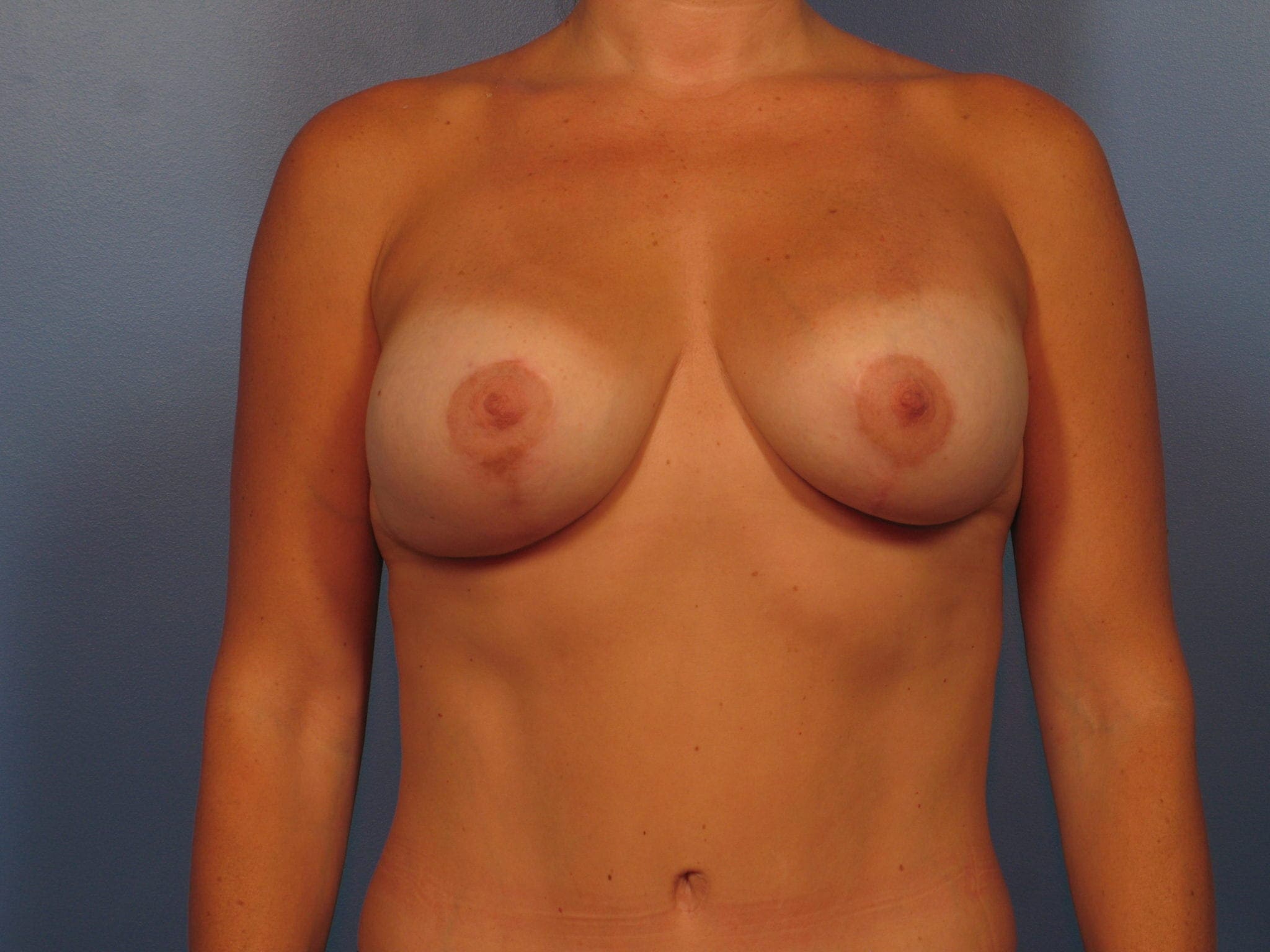 Breast Augmentation with Lift Patient Photo - Case 410a - after view-0