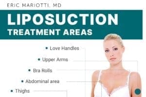 Liposuction Treatment Areas [Infographic]