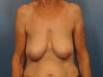 Breast Lift - Case 411 - Before