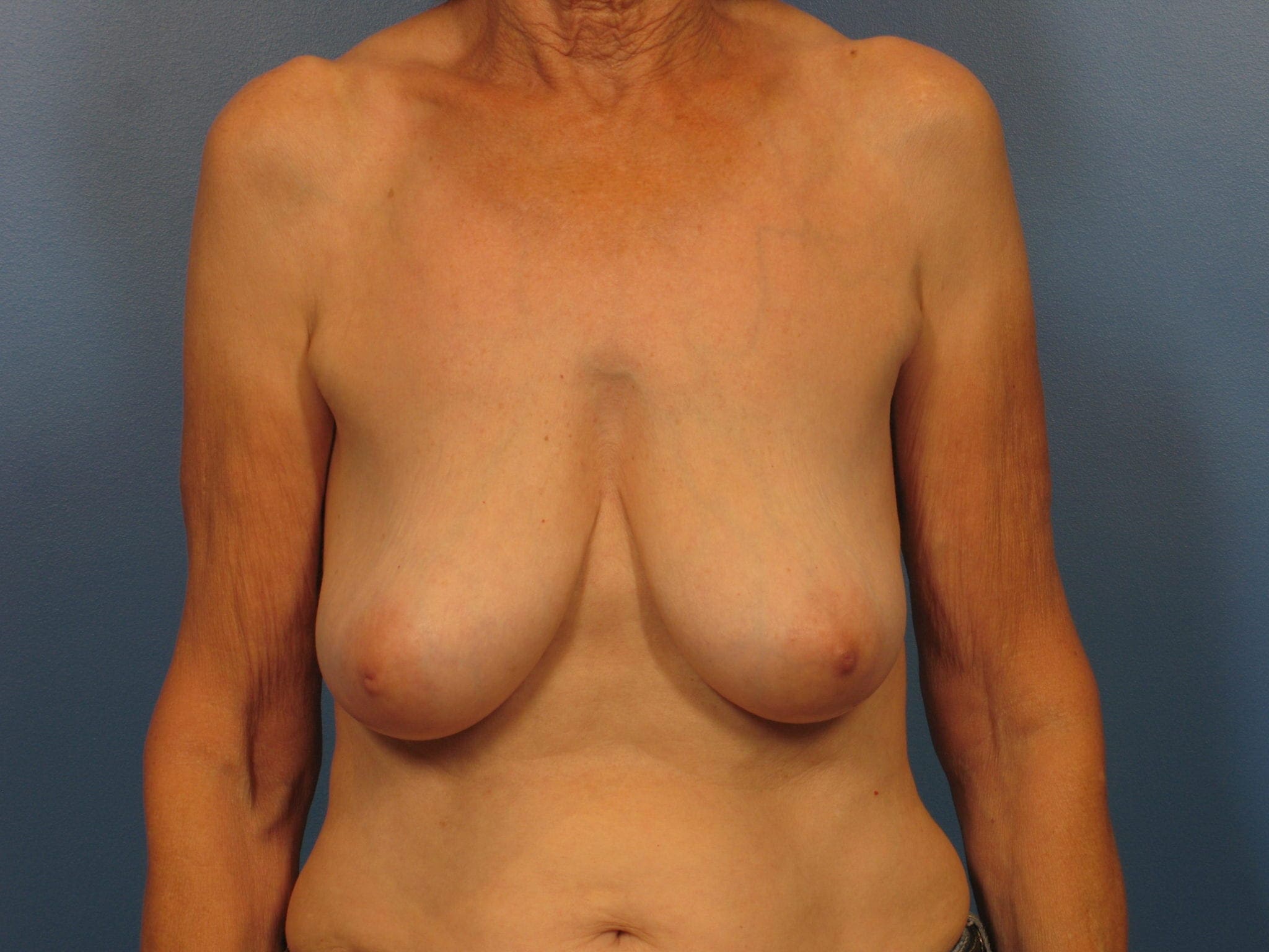 Breast Lift Patient Photo - Case 411 - before view-