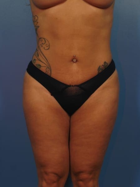 Liposuction Patient Photo - Case 413 - after view-1