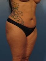 Liposuction - Case 413 - Before