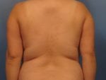 Liposuction - Case 418 - Before