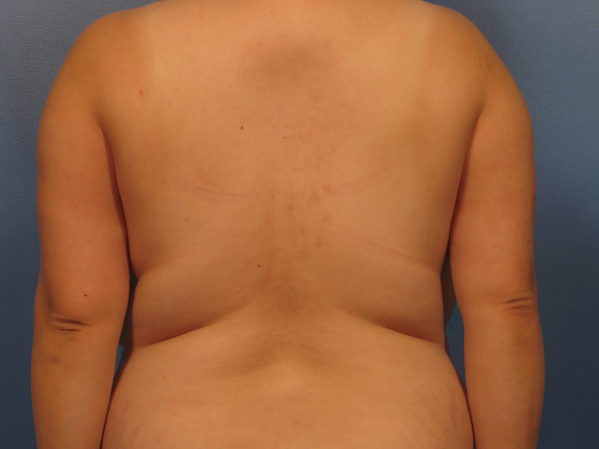 Liposuction Patient Photo - Case 418 - before view-