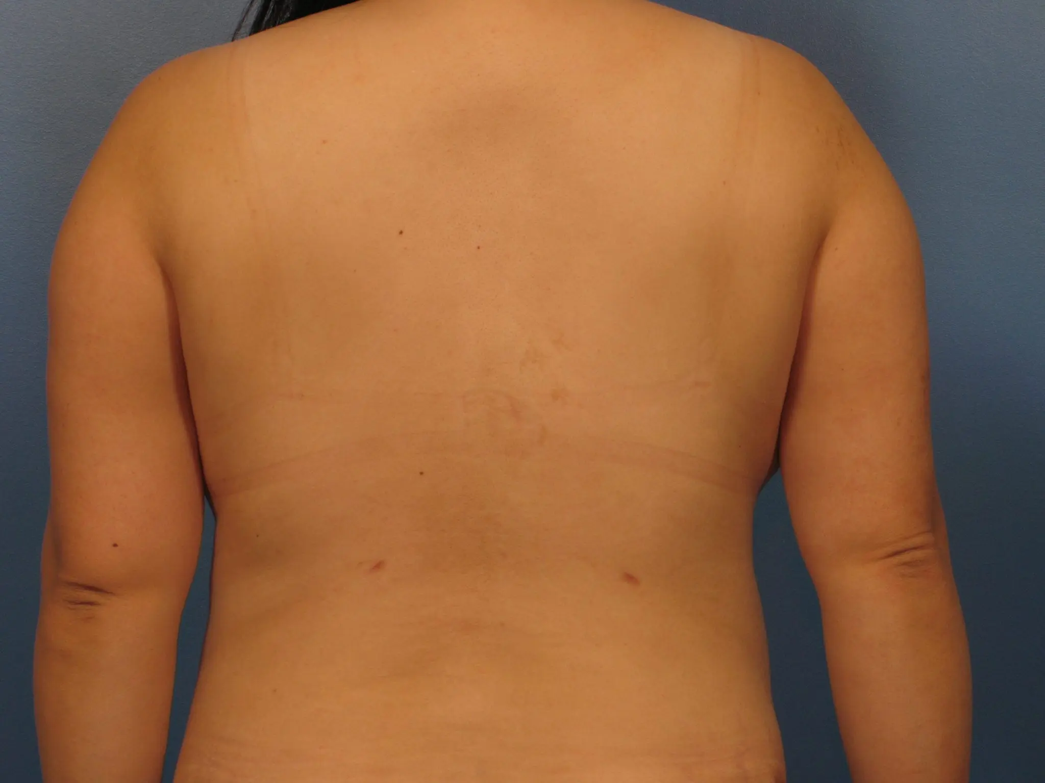 Liposuction Patient Photo - Case 418 - after view