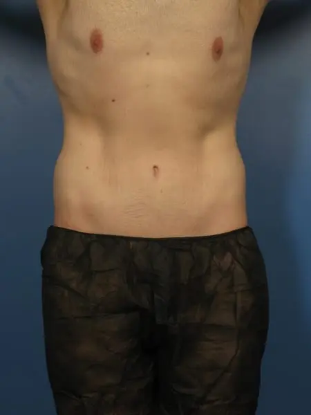 After Major Weight Loss Patient Photo - Case 428 - after view