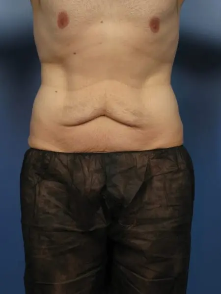 After Major Weight Loss Patient Photo - Case 428 - before view-