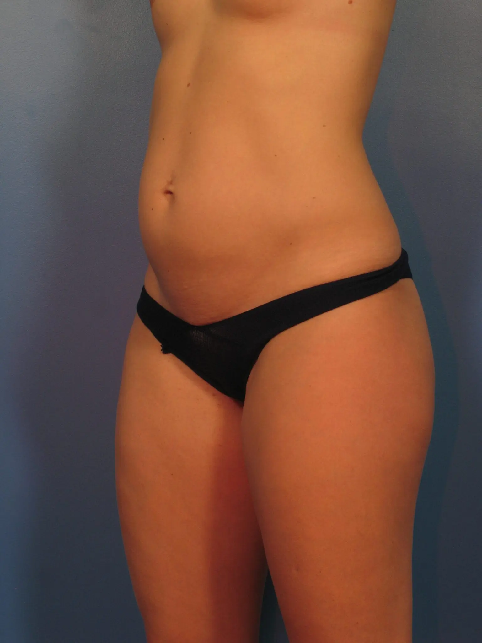 Liposuction Patient Photo - Case 422a - before view-