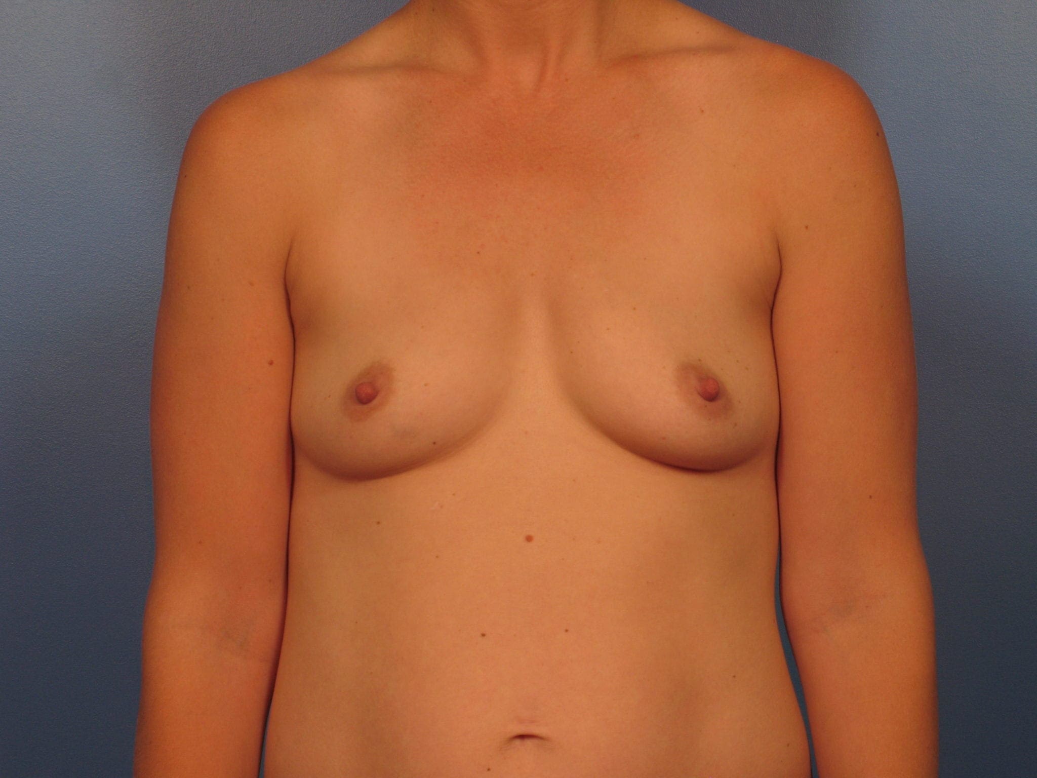 Breast Augmentation Patient Photo - Case 422b - before view-