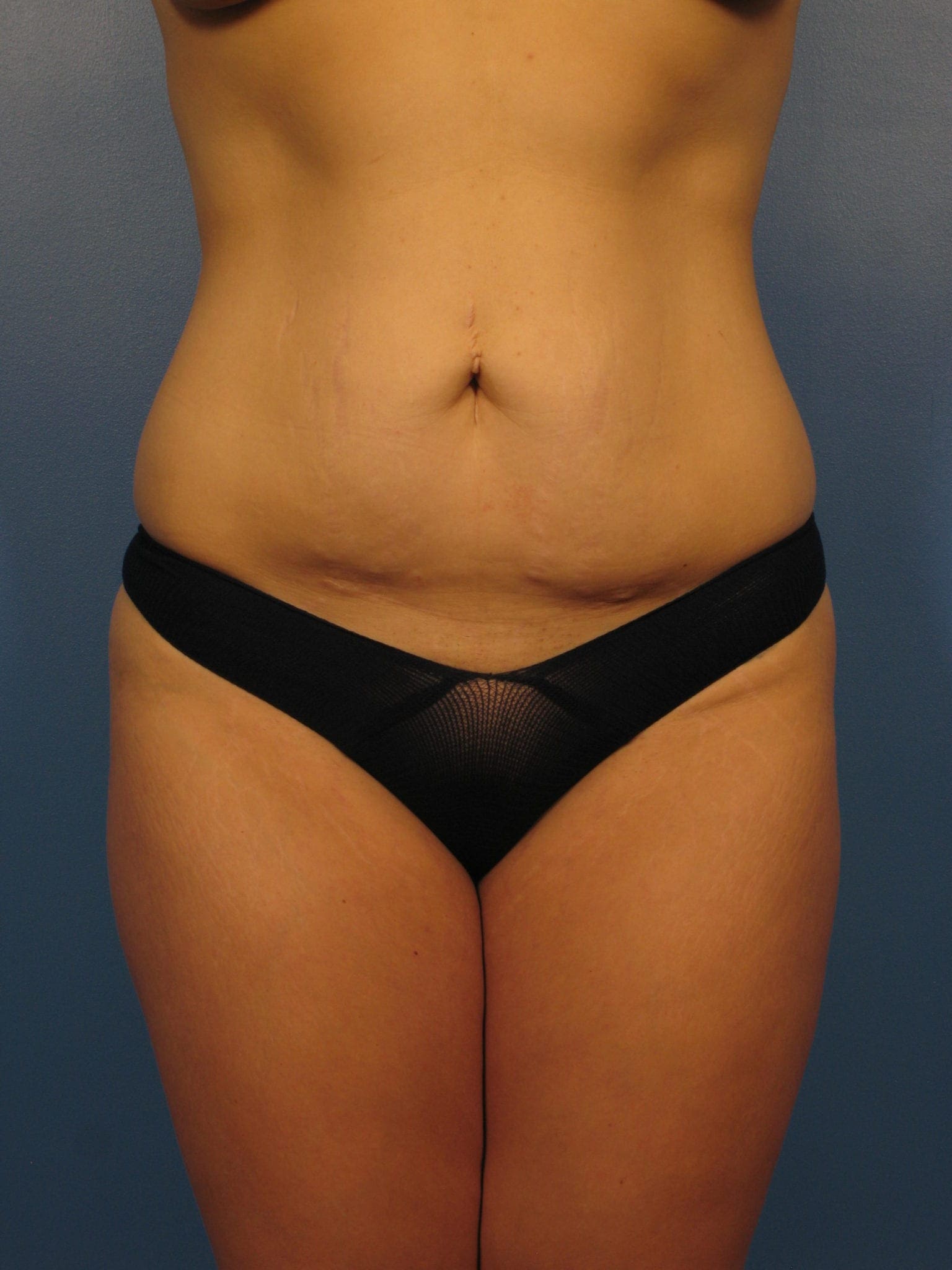 Tummy Tuck Patient Photo - Case 402 - before view-0