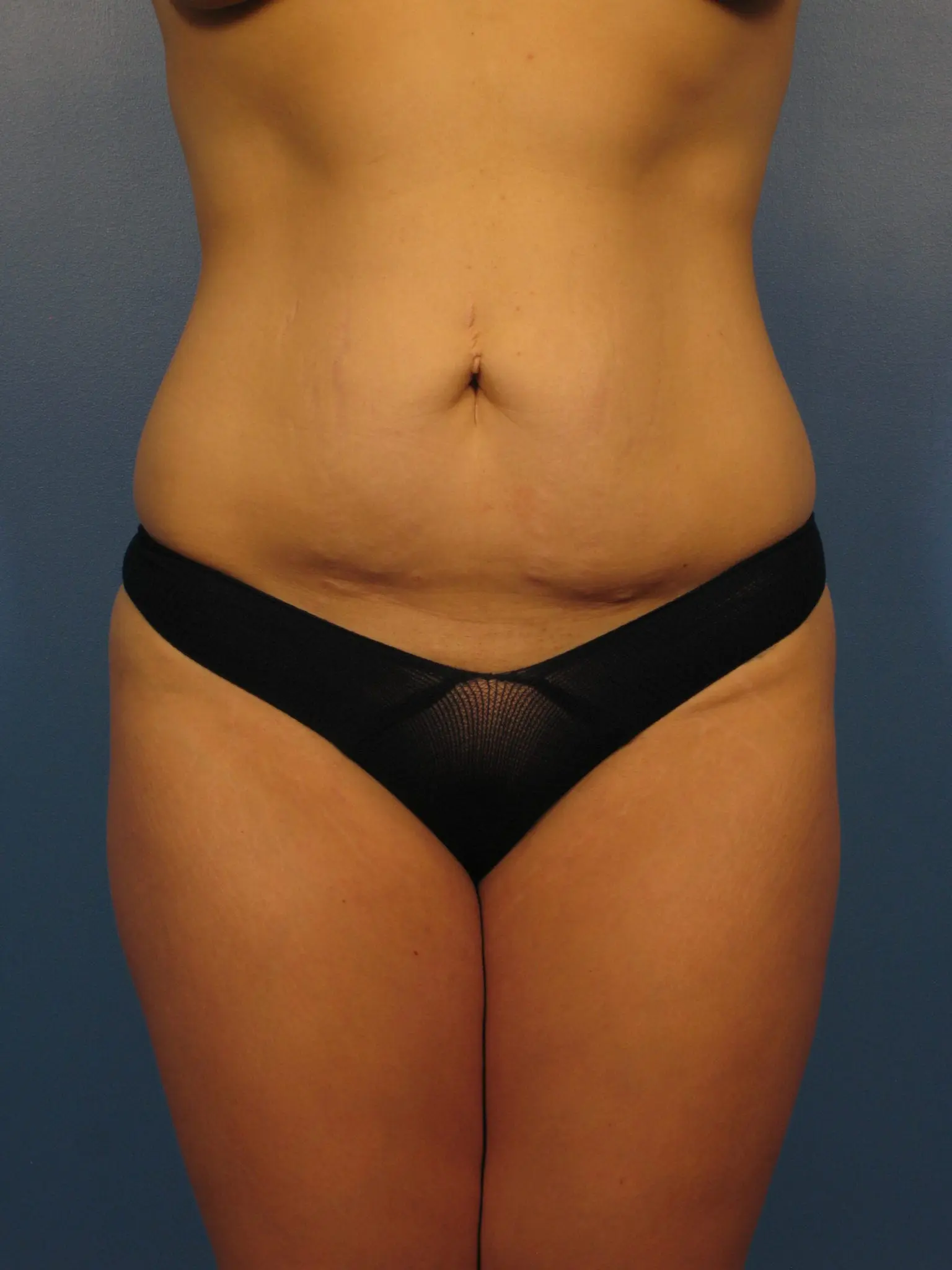 Tummy Tuck - Case 402 - Before