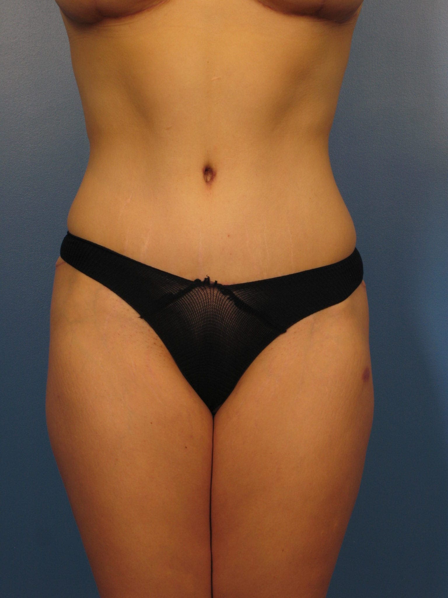 Tummy Tuck - Case 402 - After