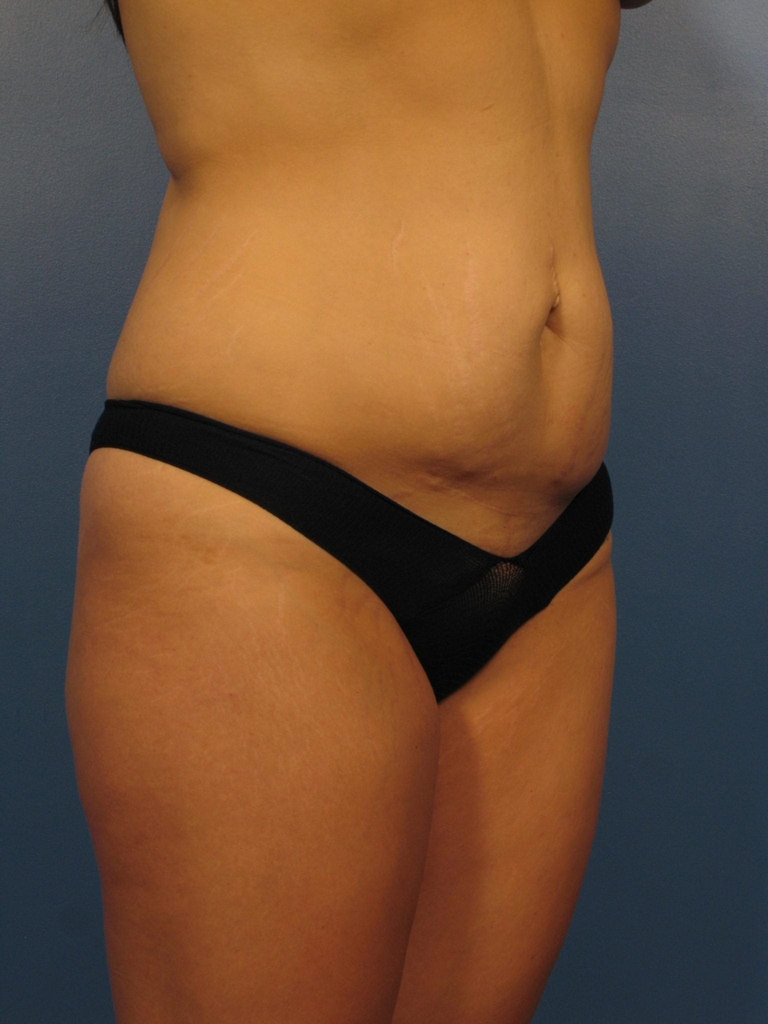 Tummy Tuck Patient Photo - Case 402 - before view-1