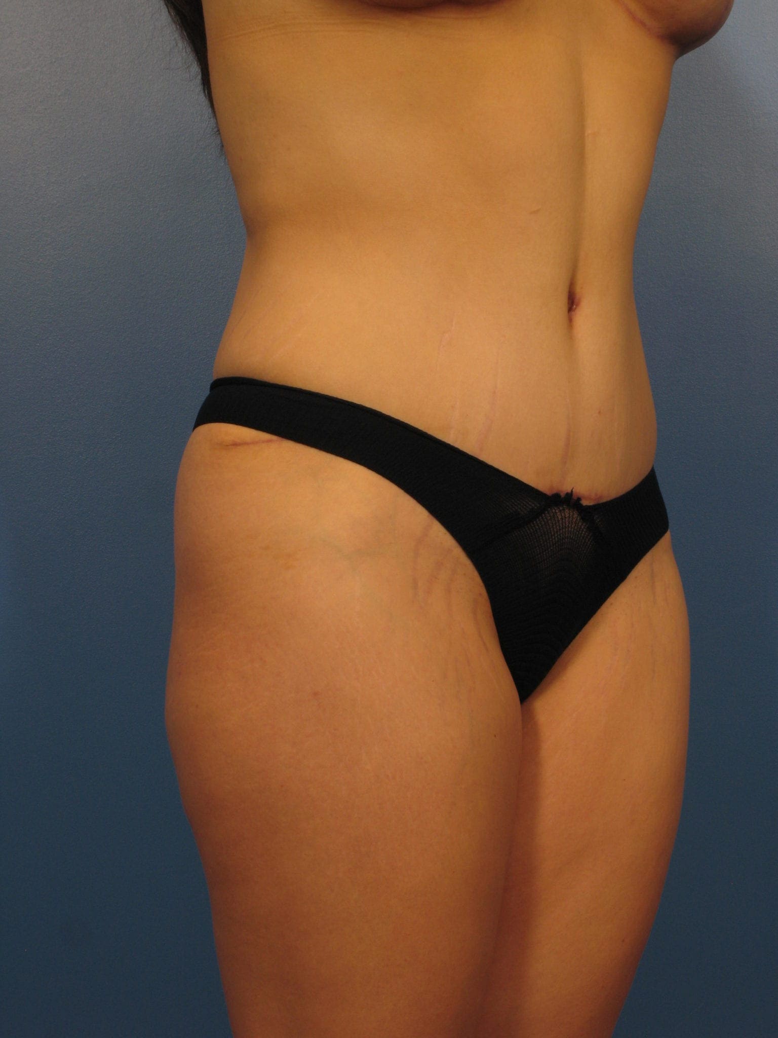 Tummy Tuck Patient Photo - Case 402 - after view-1