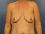 Breast Augmentation with Lift - Case 419a - Before
