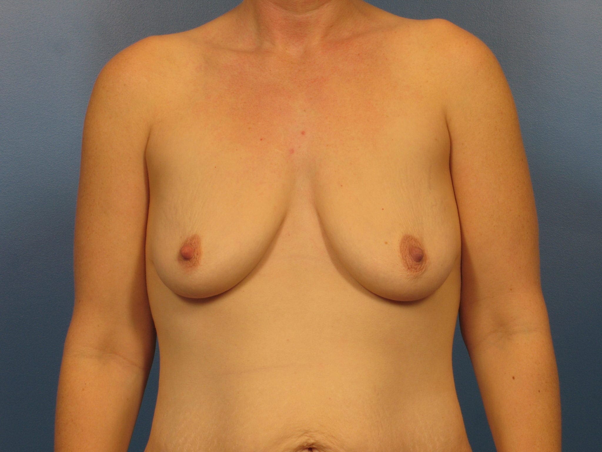 Breast Augmentation with Lift Patient Photo - Case 419a - before view-0
