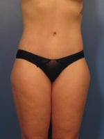 Liposuction - Case 419 - After