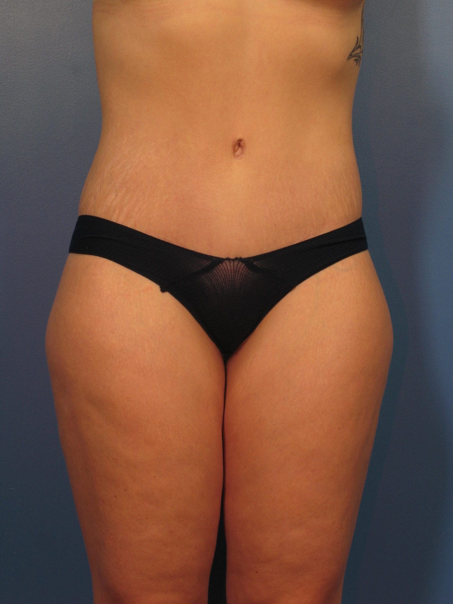 Liposuction Patient Photo - Case 419 - after view-0