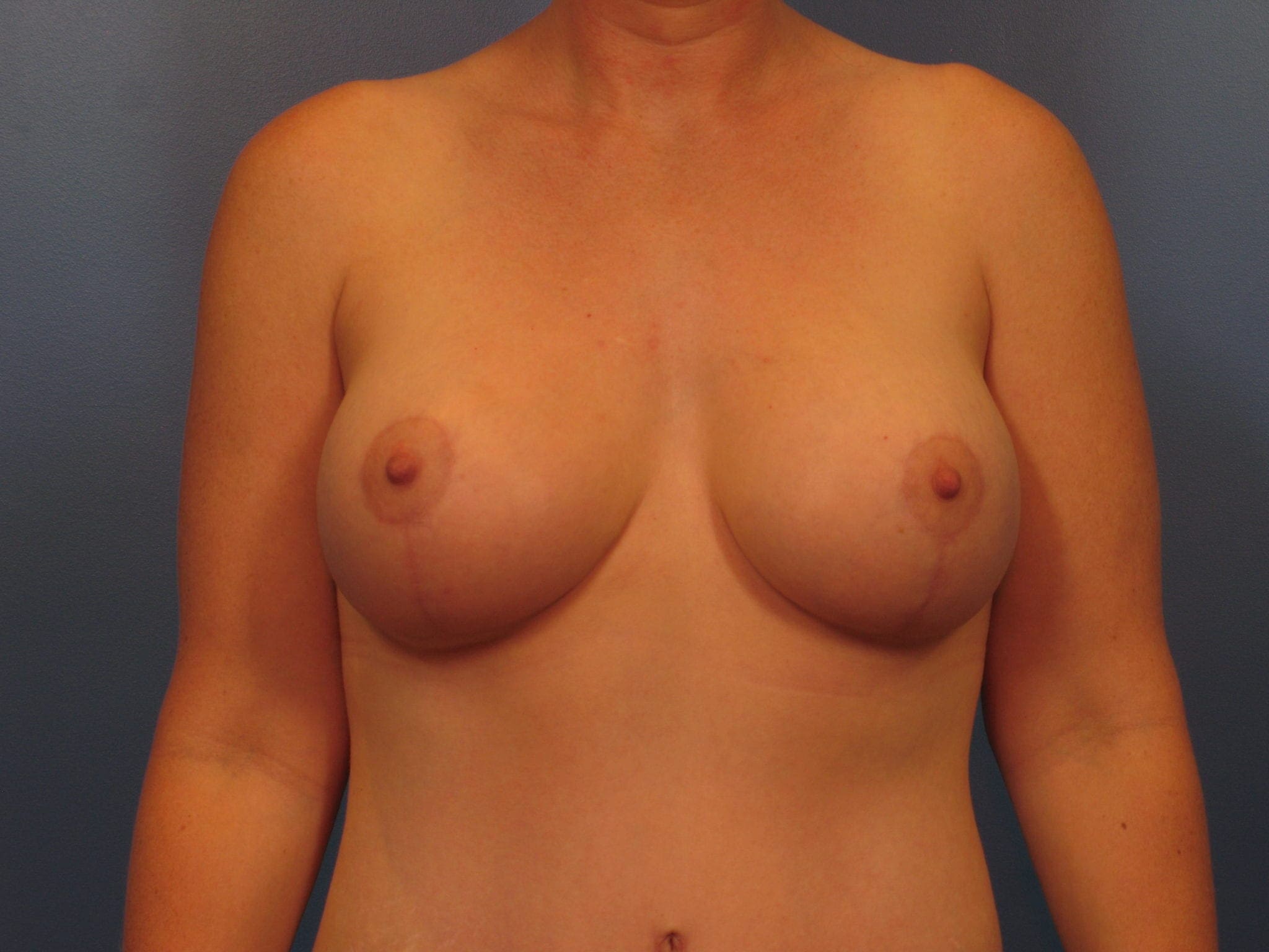 Breast Augmentation with Lift Patient Photo - Case 419a - after view