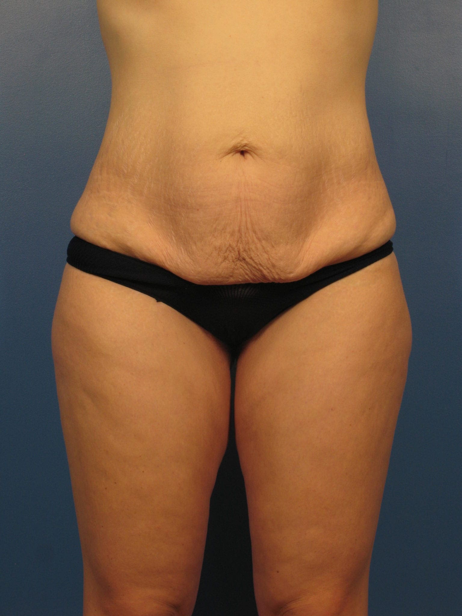 Liposuction - Case 419 - Before
