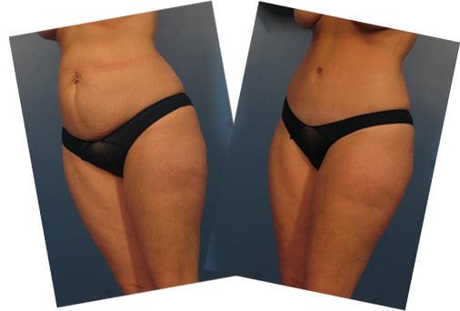 Tummy Tuck Before After Featured
