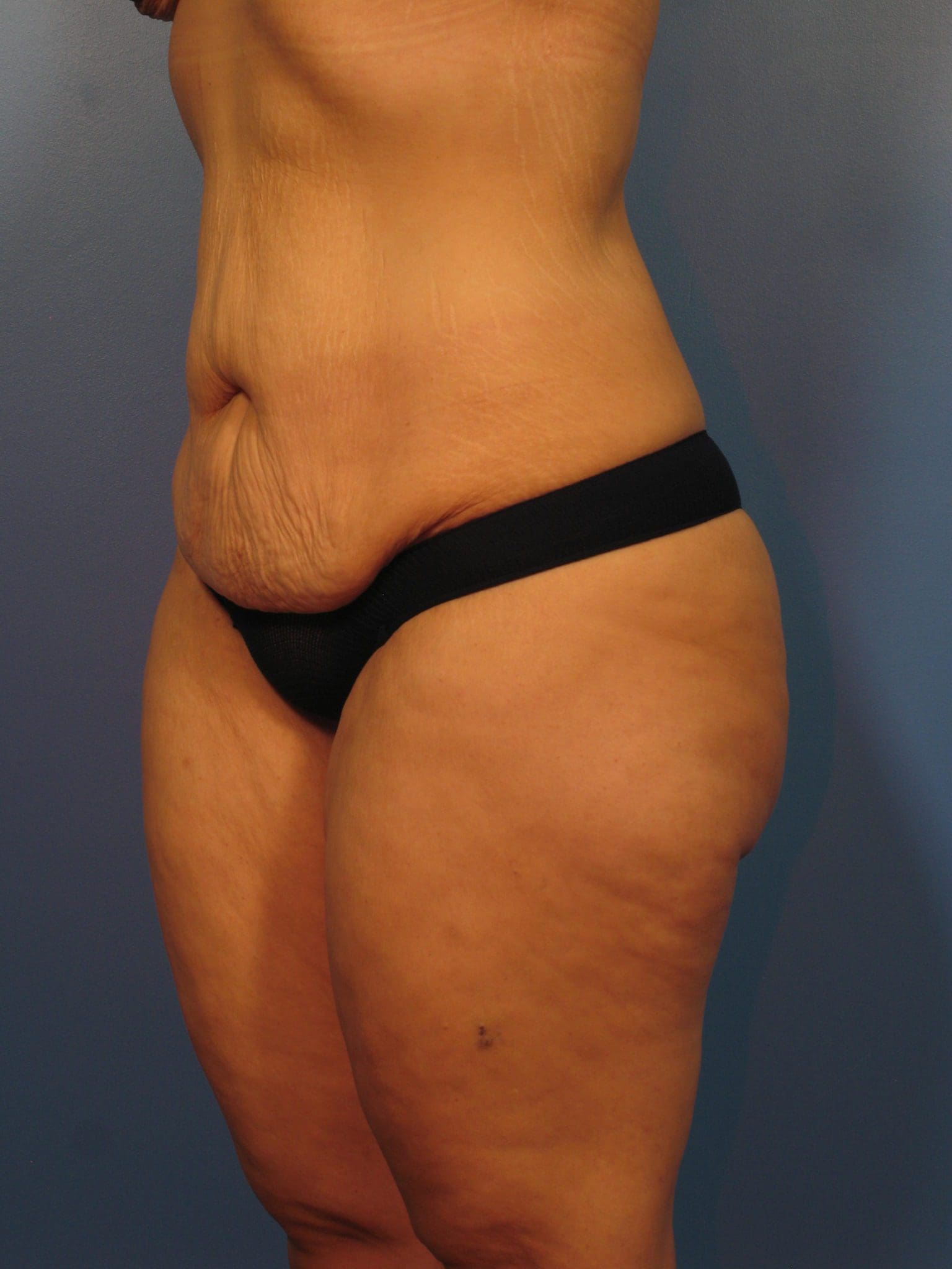 Tummy Tuck Patient Photo - Case 14333 - before view-1