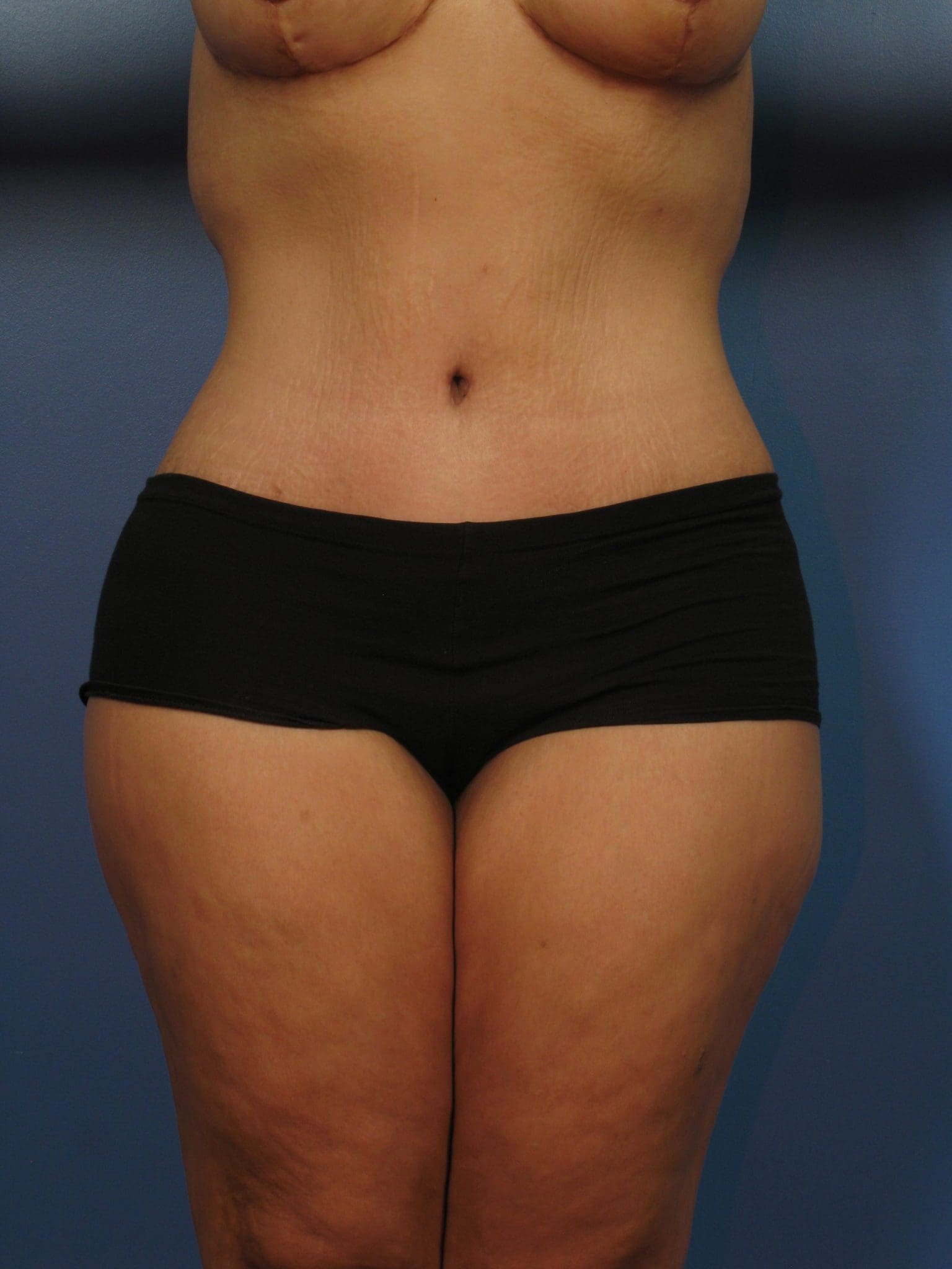 Tummy Tuck - Case 14333 - After
