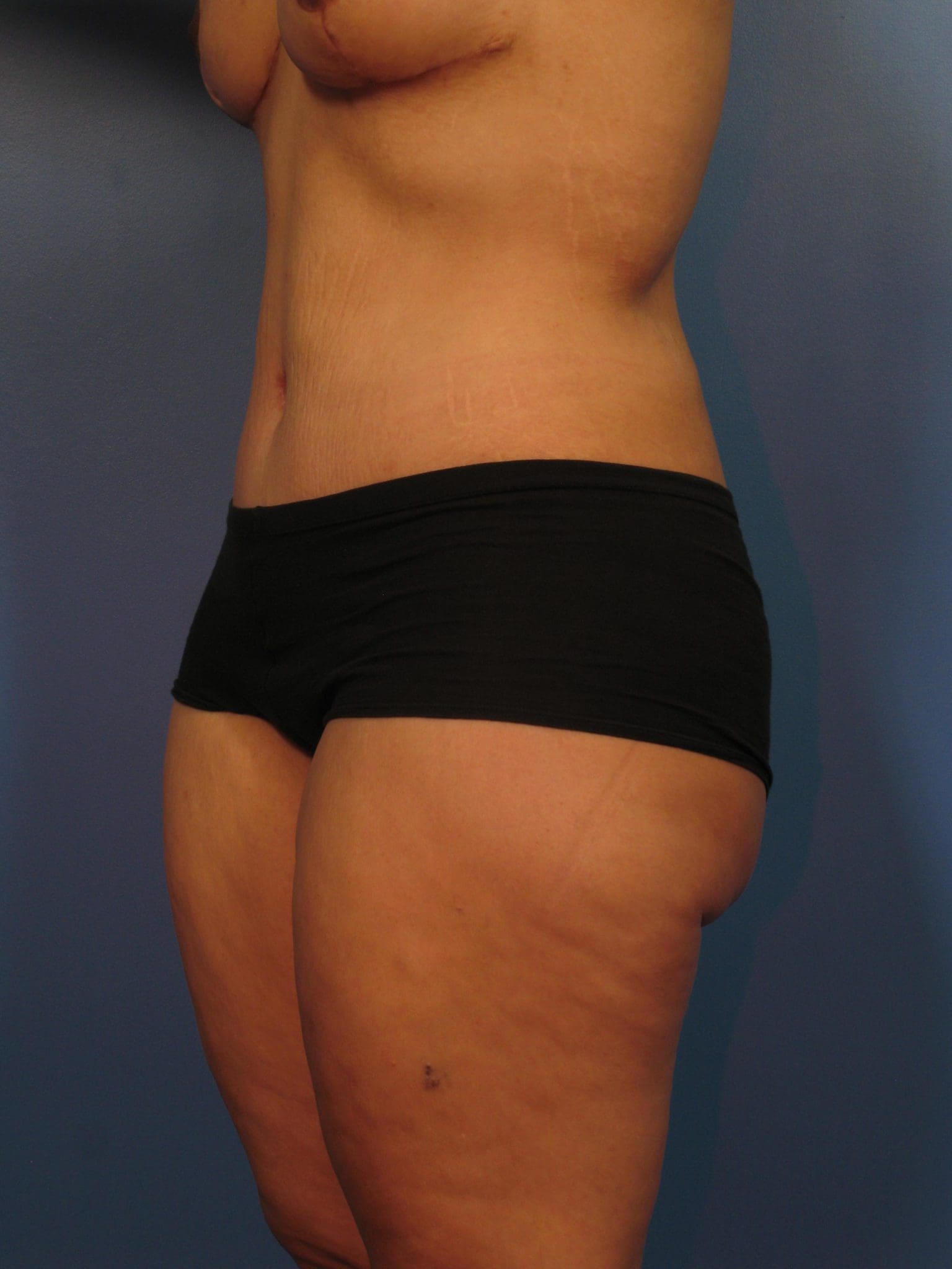 Tummy Tuck Patient Photo - Case 14333 - after view-1