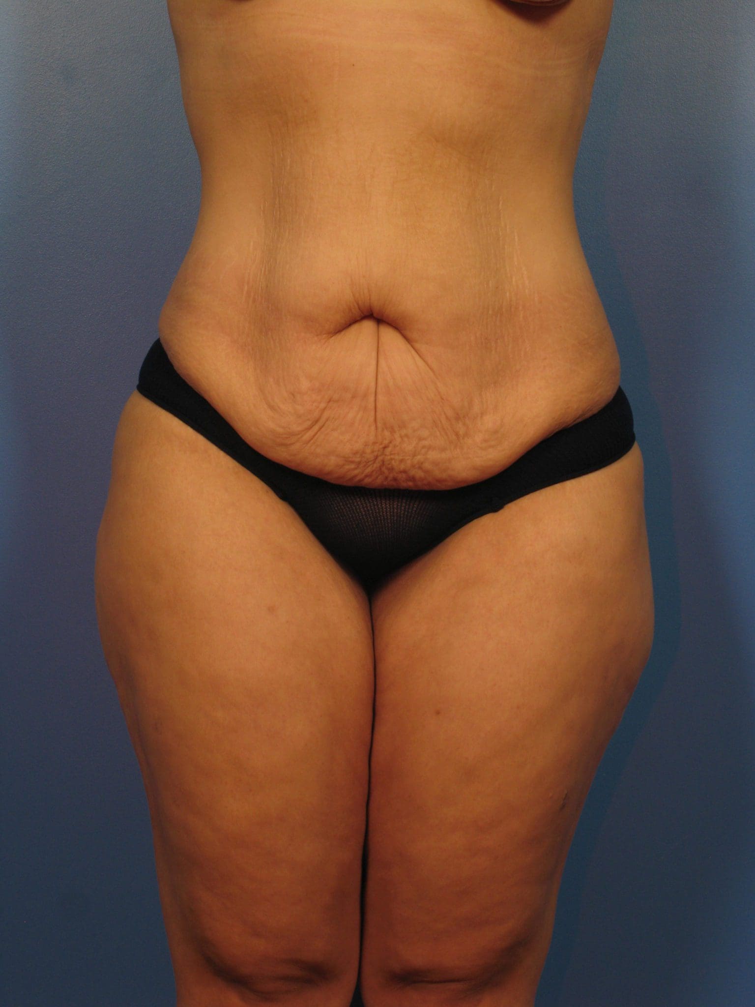 Tummy Tuck Patient Photo - Case 14333 - before view-0