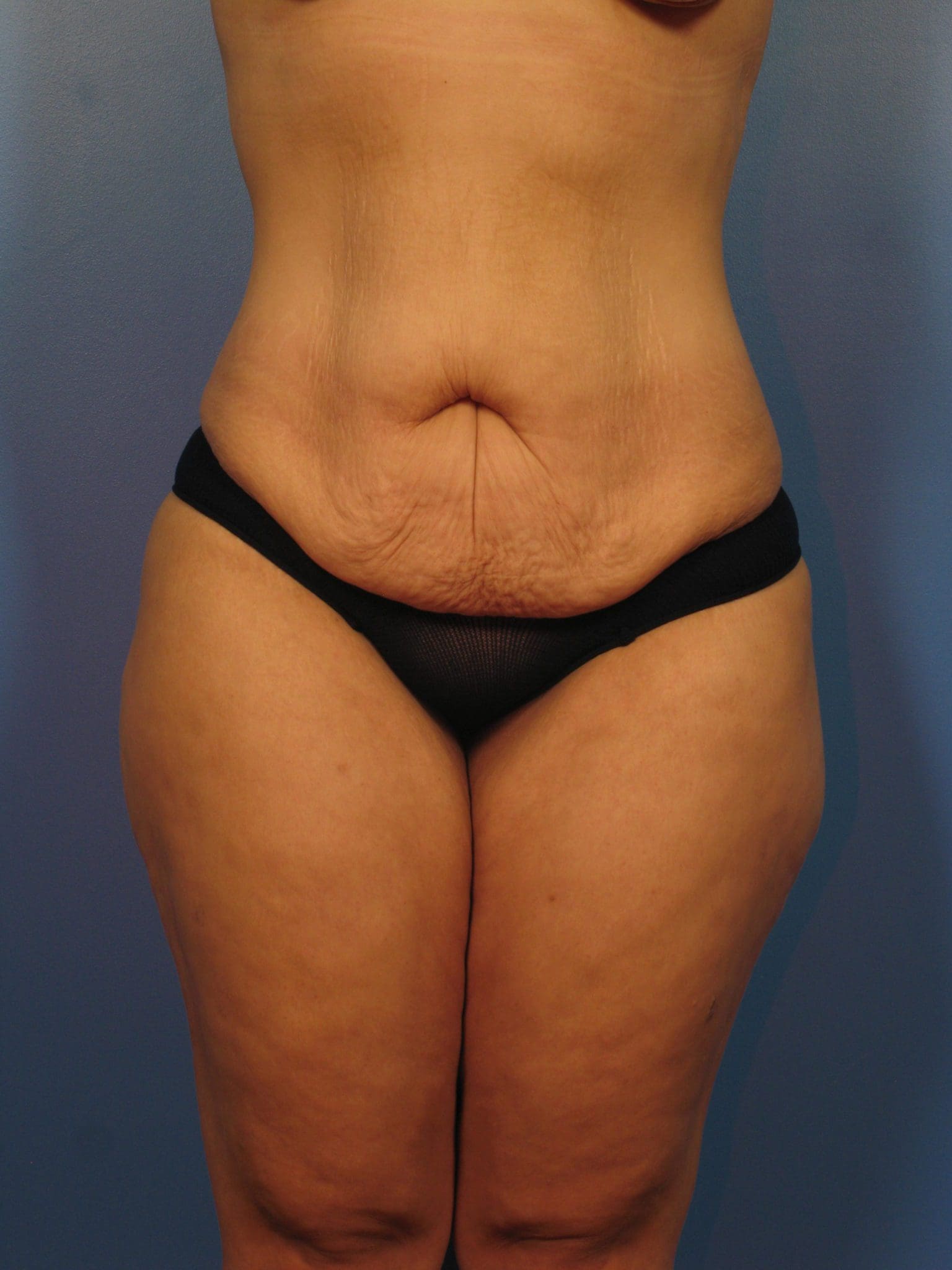 Tummy Tuck - Case 14333 - Before