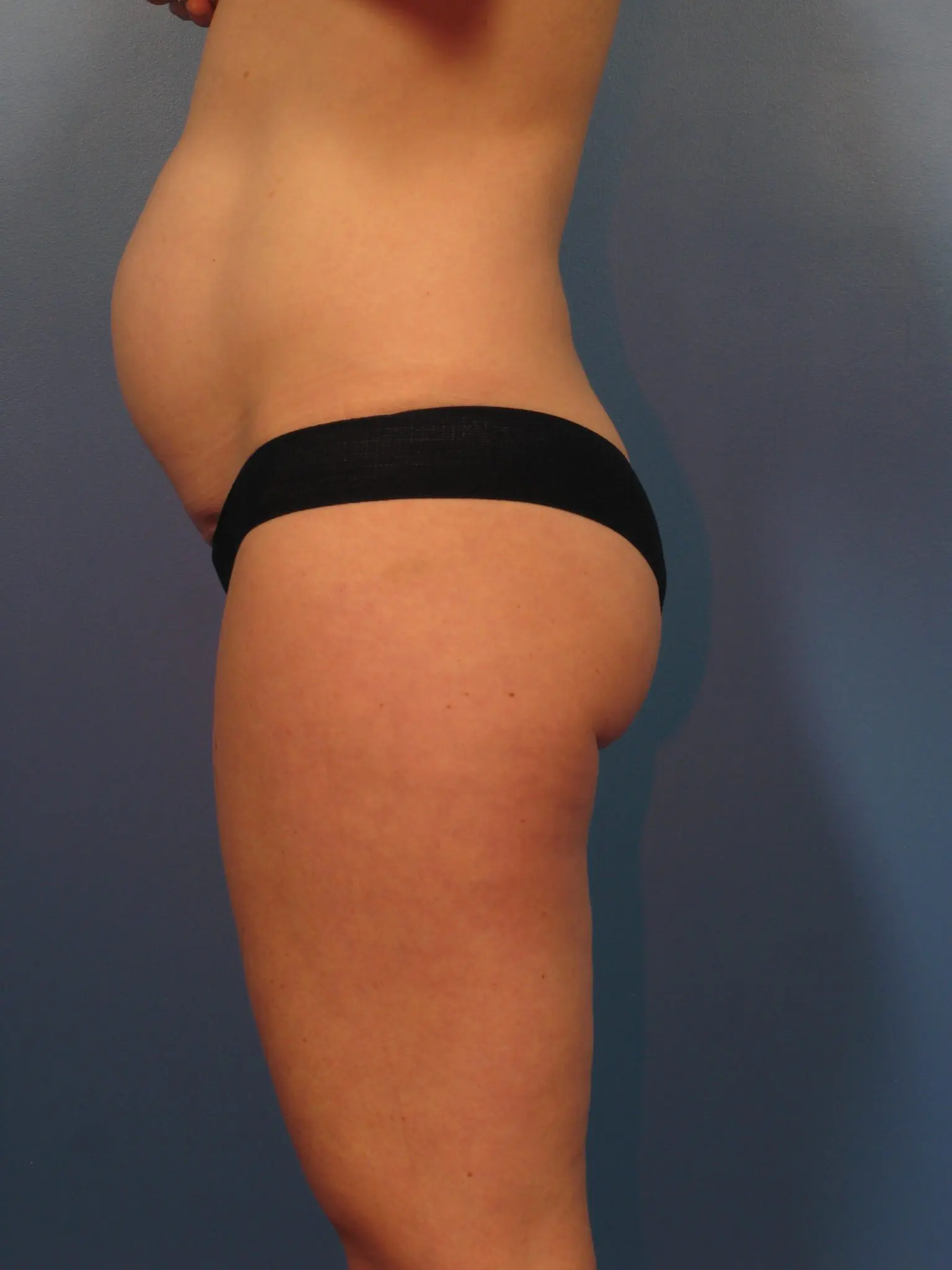 Tummy Tuck - Case 14339 - Before