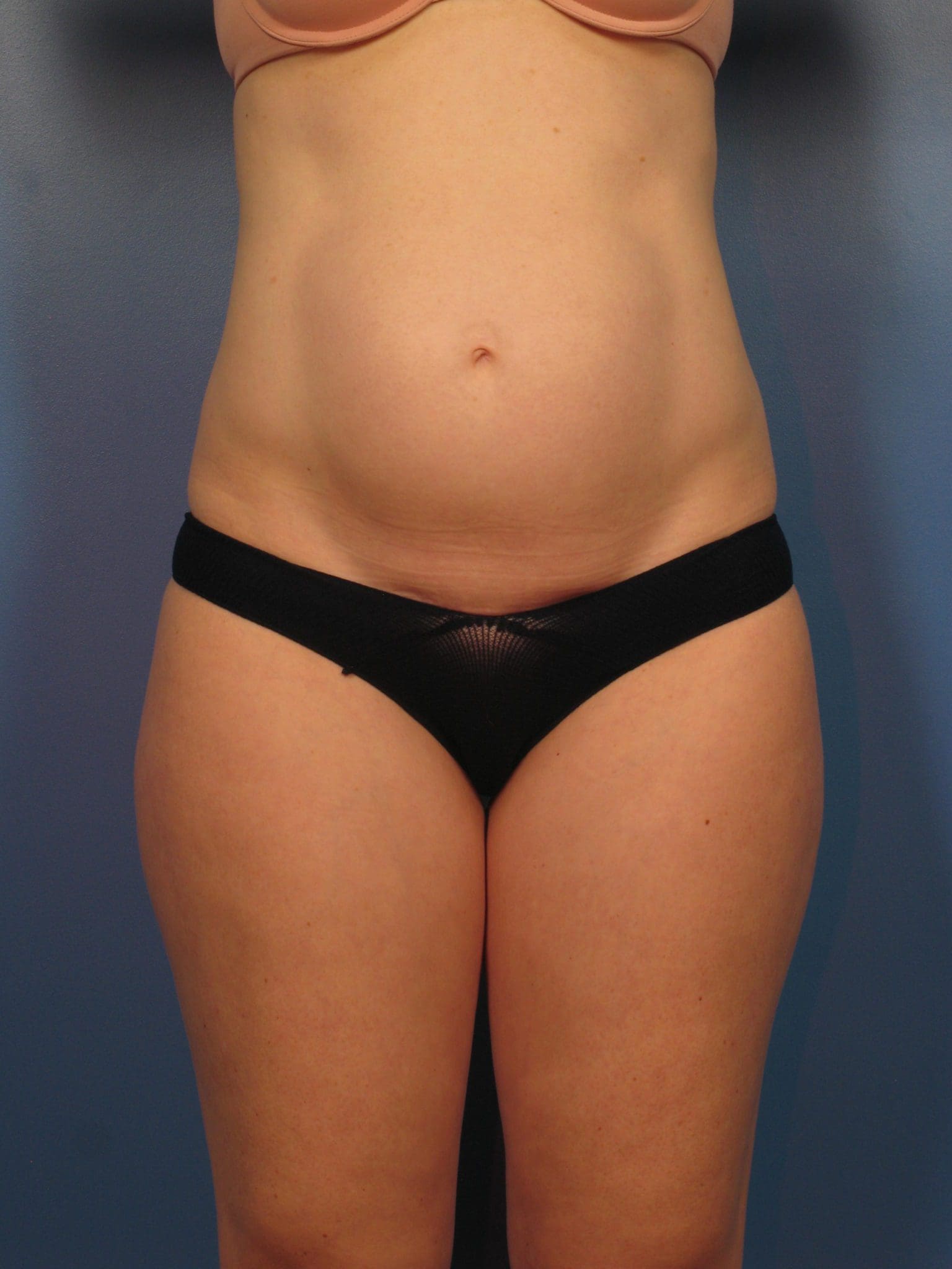 Tummy Tuck Patient Photo - Case 14339 - before view-2