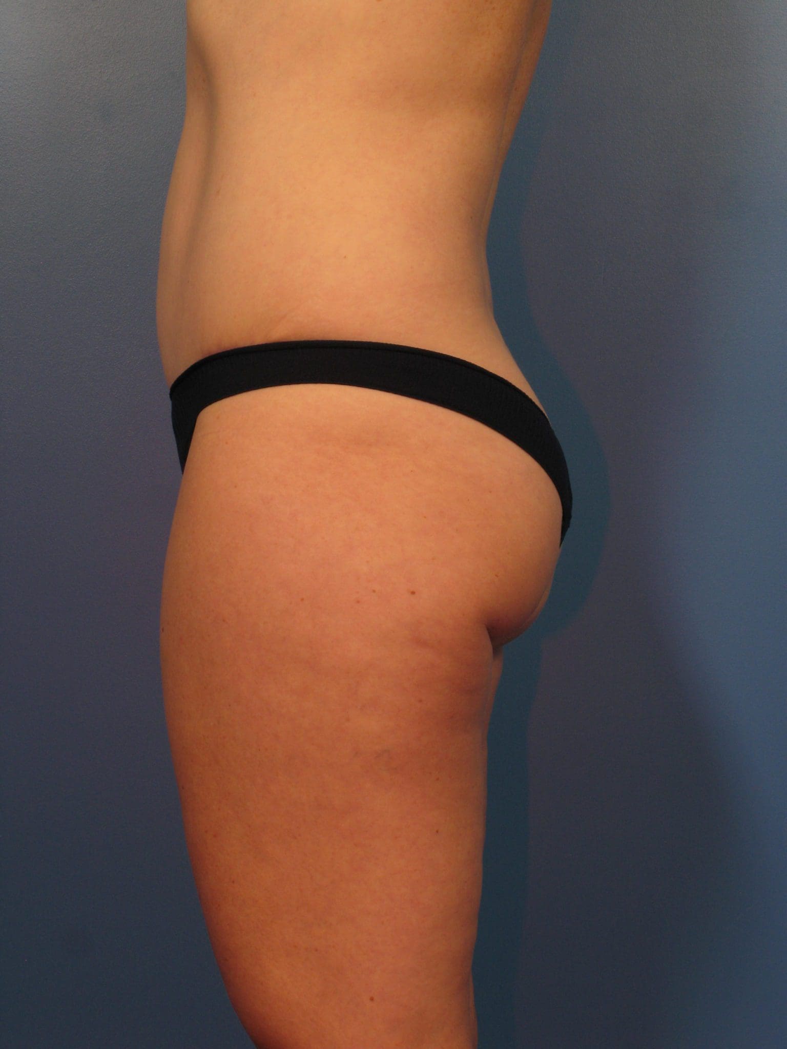 Tummy Tuck Patient Photo - Case 14339 - after view