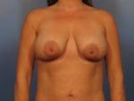 Breast Augmentation with Lift - Case 14347 - Before
