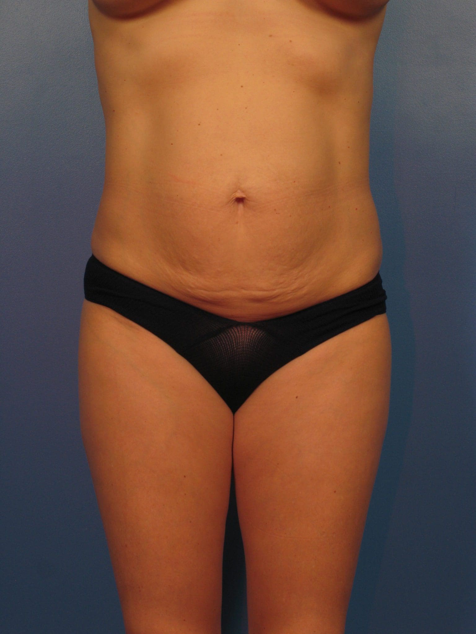 Breast Augmentation with Lift Patient Photo - Case 14347 - before view-2