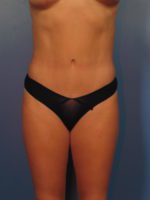 Tummy Tuck - Case 14347 - After