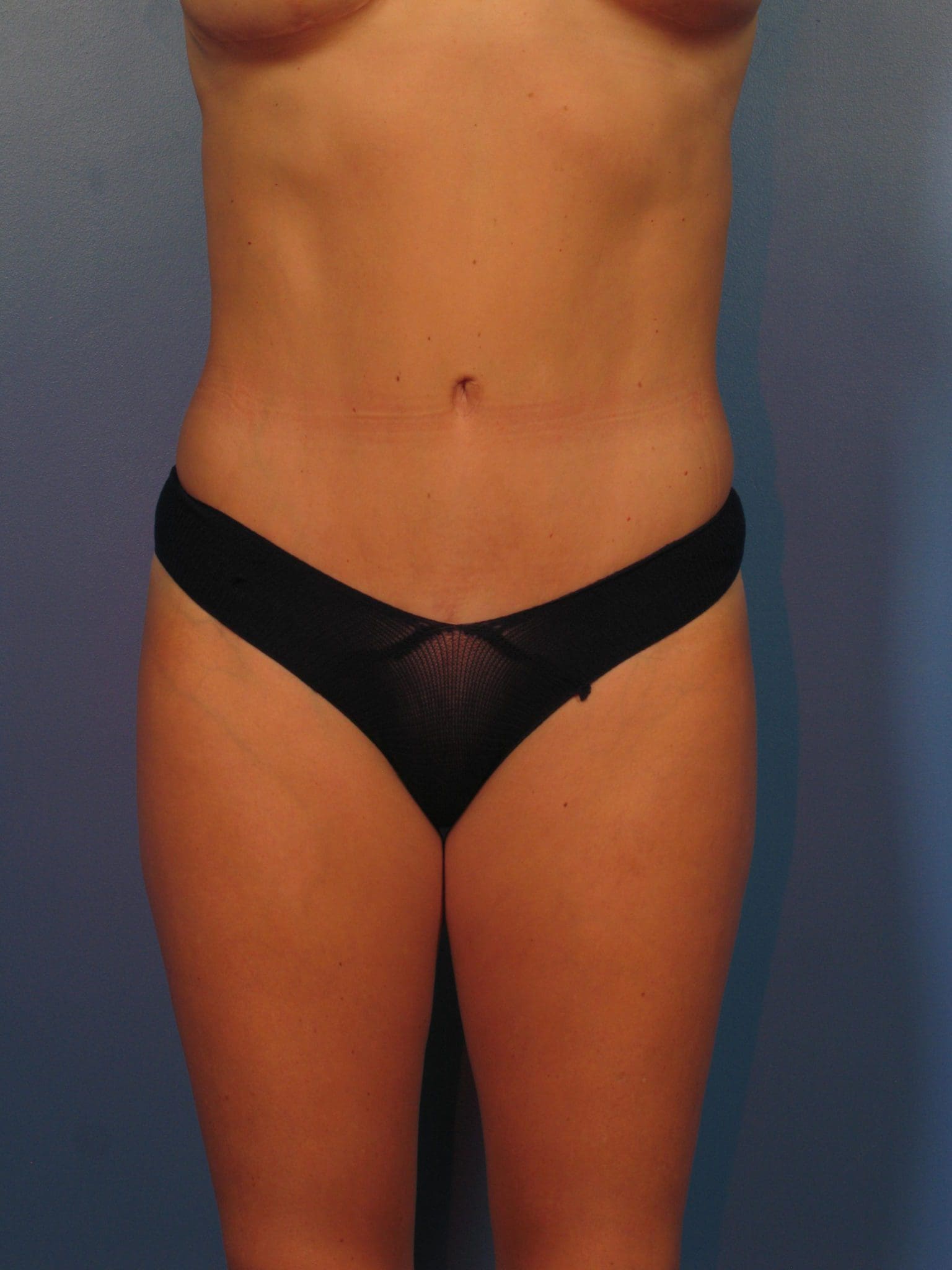 Breast Augmentation with Lift Patient Photo - Case 14347 - after view-2