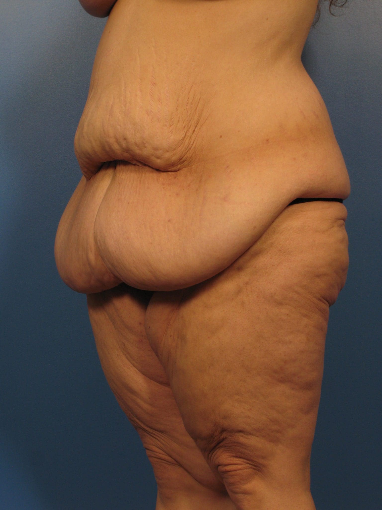 Tummy Tuck Patient Photo - Case 14361 - before view-1