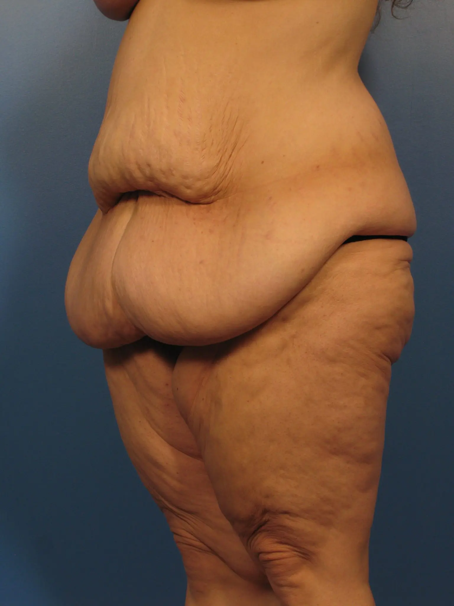 After Major Weight Loss Patient Photo - Case 1043 - before view-1